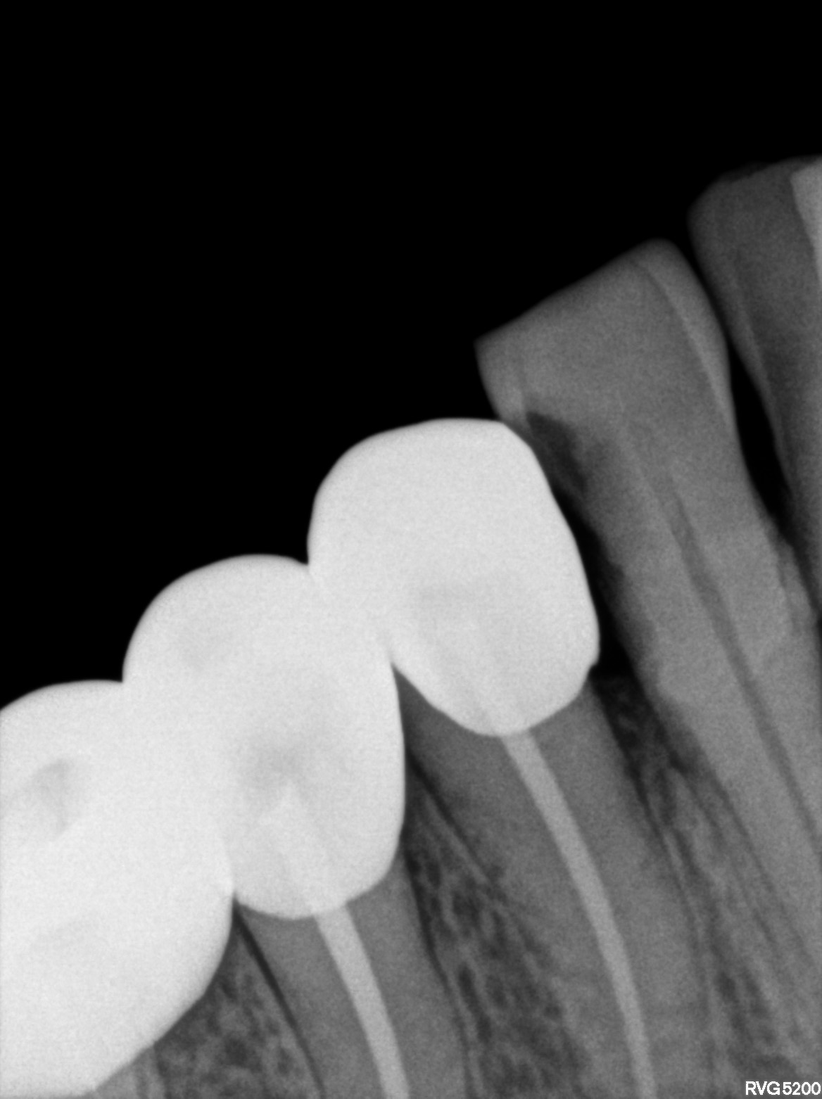 Dental X-ray